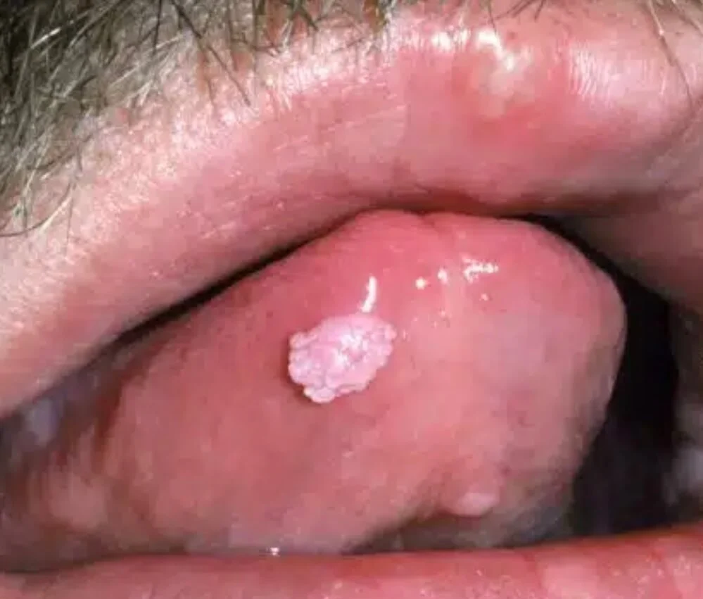 Papilloma (jóindulatú laphám-daganat) a nyelv felszínén – eltávolítás előtti állapot - aminomed.hu