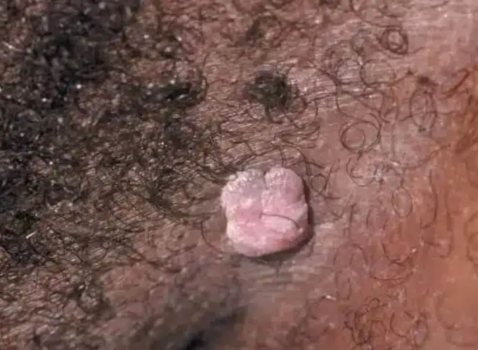 Bőrkinövés eltávolítása előtti állapot – szemölcsszerű elváltozás szőrtüszős területe - aminomed.hu