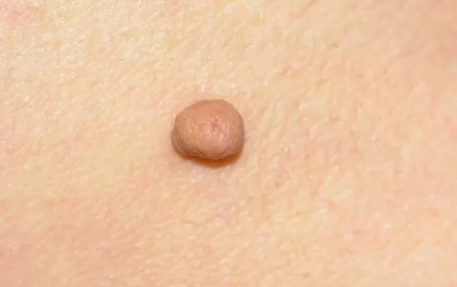 Bőrkinövés eltávolítása előtti állapot – anyajegyhez hasonló elváltozás a bőrön - aminomed.hu