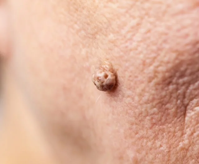 Bőrkinövés eltávolítása előtti állapot – szemölcsszerű elváltozás az arcbőrön - aminomed.hu
