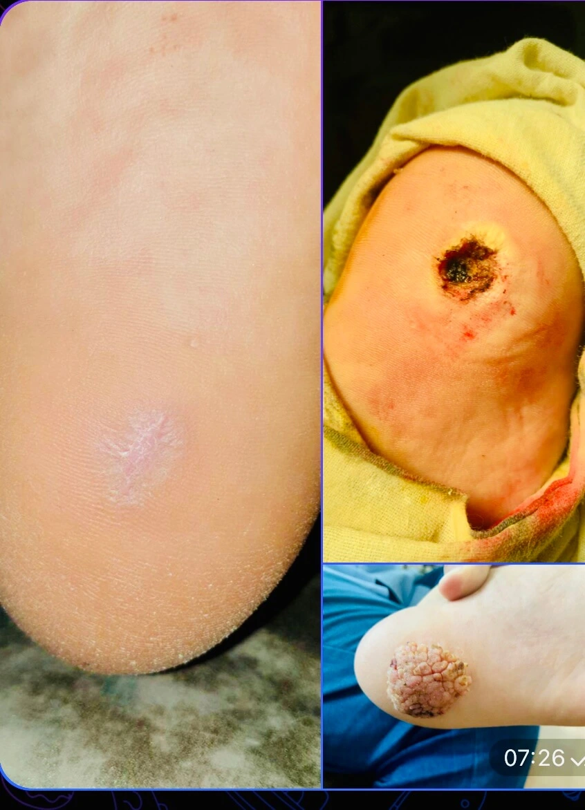 Verruca plantaris (talpi szemölcs) eltávolítás előtti és utáni állapot – gyógyulási folyamat bemutatása - aminomed.hu