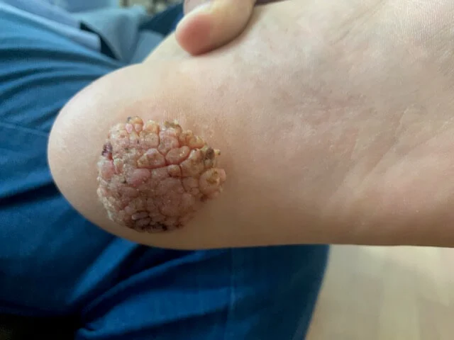 Verruca plantaris (talpi szemölcs) eltávolítás előtti és utáni állapot – gyógyulási folyamat bemutatása - aminomed.hu